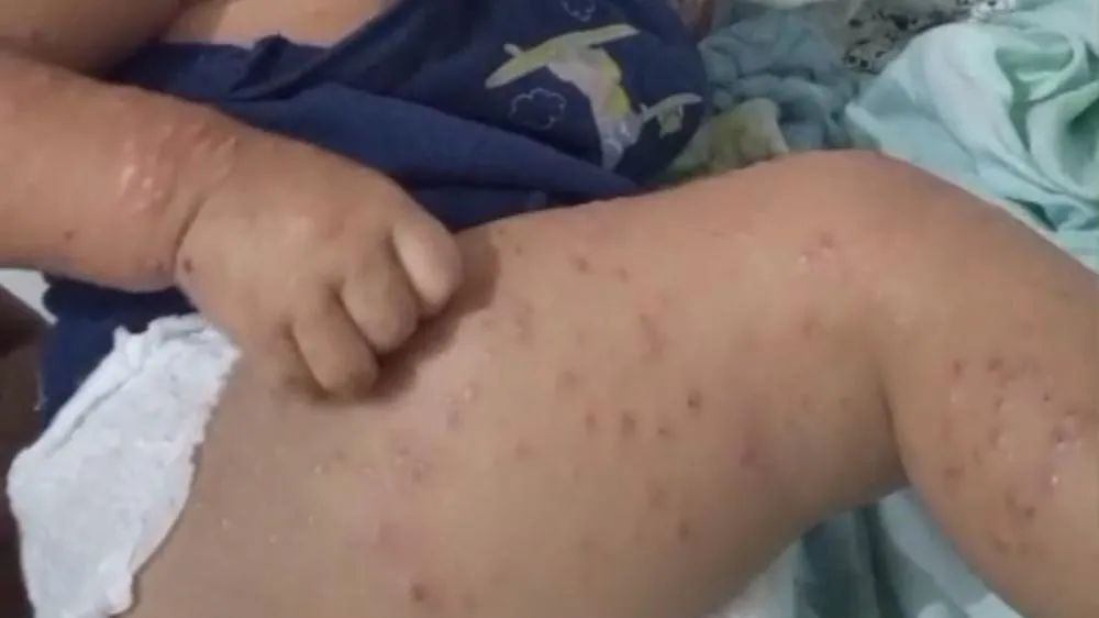 Mãe busca ajuda especializada para tratar quadro dermatológico grave em bebê de 1 ano e 6 meses