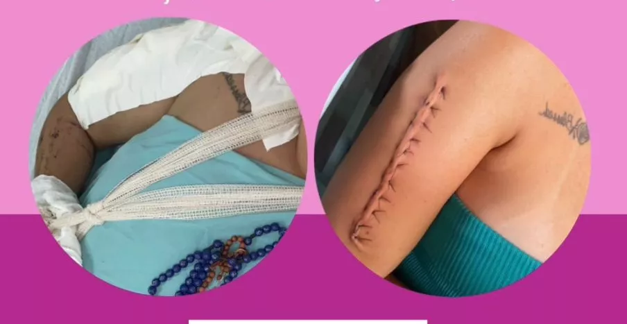 Jovem de Patos faz campanha para custear fisioterapia após grave acidente de moto na PB-228